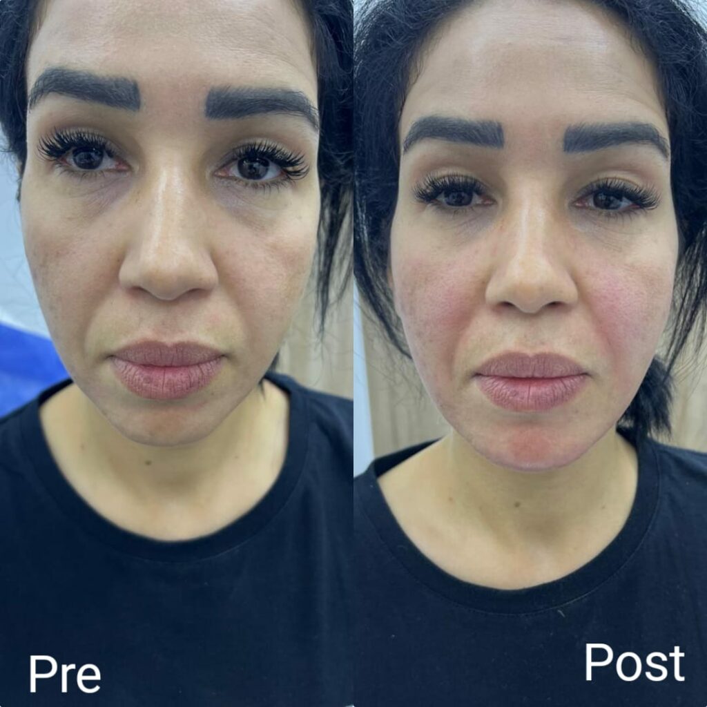 حقن سكلبترا في الغردقة